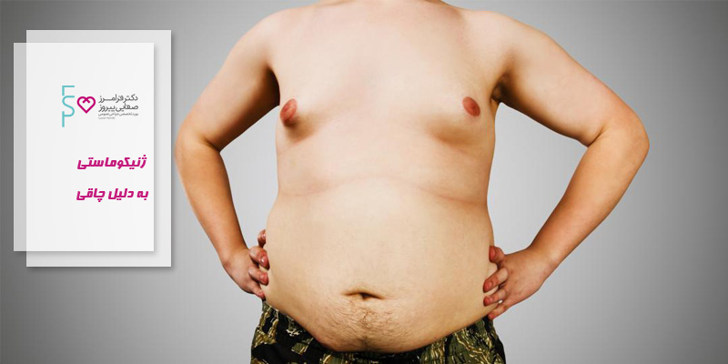 ژنیکوماستی به دلیل چاقی